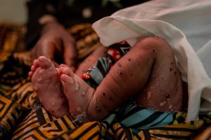 mpox-patient-drc-august-2024.tmb-1200v.jpg